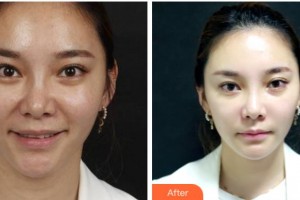 金華芘麗芙（原華美）整形醫(yī)院鄧亮整形價(jià)格表附埋線提升案例展示