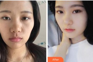 金華芘麗芙（原華美）整形醫(yī)院張弘整形價(jià)格表附熱瑪吉案例展示