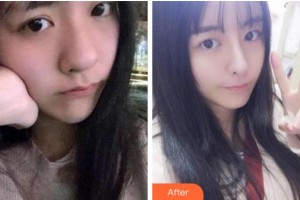 金華美辰醫(yī)療美容醫(yī)院嚴(yán)晟整形價格表附熱瑪吉案例展示