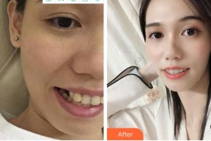 金華美辰醫(yī)療美容醫(yī)院涂強(qiáng)整形價格表附金屬托槽矯正案例展示