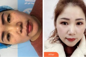 金華康美醫(yī)療美容綜合門診部孫傳整形價格表附定點(diǎn)雙眼皮案例展示