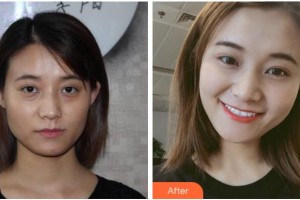 金華三星(原協(xié)和)整形醫(yī)院申鉉德整形價格表附埋線提升案例展示