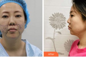 金華亞美整形美容醫(yī)院鄧澤臣整形價格表附埋線提升案例展示