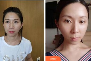 金華芘麗芙（原華美）整形醫(yī)院金凡穎整形價格表附熱拉提案例展示