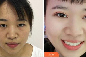 金華康美醫(yī)療美容綜合門診部劉興權(quán)整形價格表附定點(diǎn)雙眼皮案例展示