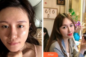 金華康美醫(yī)療美容綜合門診部洪鋼整形價格表附埋線提升案例展示