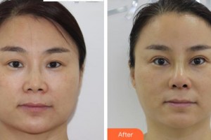 金華亞美整形美容醫(yī)院薛磊整形價格表附切開雙眼皮案例展示