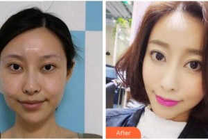 金華藝馨醫(yī)療美容門診部杜曦整形價(jià)格表附埋線提升案例展示