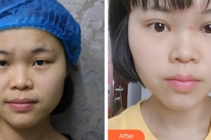 金華愛爾眼科醫(yī)院孫忠海整形價(jià)格表附切開雙眼皮案例展示