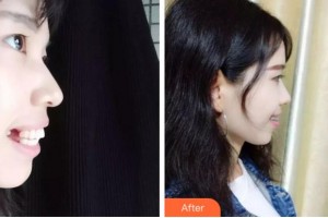 金華周亞軍口腔門診部周亞軍整形價(jià)格表附隱形托槽矯正案例展示