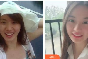 金華婁城口腔醫(yī)院傅安業(yè)整形價(jià)格表附金屬托槽矯正案例展示