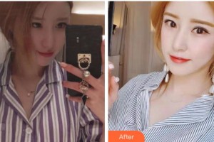 金華市人民醫(yī)院整形美容中心蔡陽群整形價(jià)格表附祛眼袋案例展示