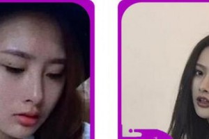 金華市人民醫(yī)院整形美容中心胡維君整形價(jià)格表附切開雙眼皮案例展示