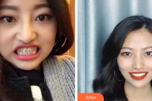 金華口腔醫(yī)院李倩整形價(jià)格表附美白貼片案例展示