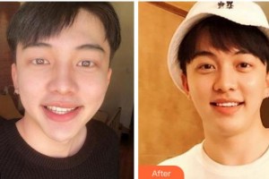 金華口腔醫(yī)院楊道路整形價(jià)格表附美白貼片案例展示