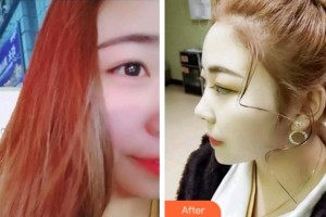 金華口腔醫(yī)院潘鵬程整形價(jià)格表附超聲波潔牙案例展示