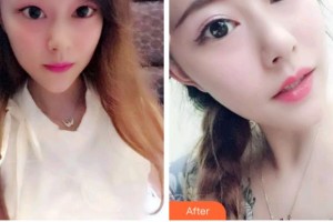 金華口腔醫(yī)院劉忠臣整形價(jià)格表附牙貼面案例展示