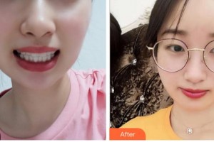 金華口腔醫(yī)院鄧靜艷整形價(jià)格表附牙齒隱形矯正案例展示