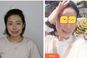 金華口腔醫(yī)院陳丹整形價(jià)格表附牙齒隱形矯正案例展示