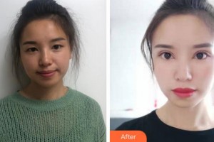 金華愛爾眼科醫(yī)院趙斌整形價(jià)格表附切開雙眼皮案例展示