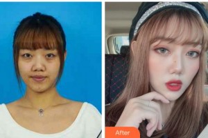 金華愛爾眼科醫(yī)院毛景璟整形價格表附切開雙眼皮案例展示