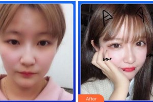 金華愛爾眼科醫(yī)院陳林勇整形價格表附埋線雙眼皮案例展示