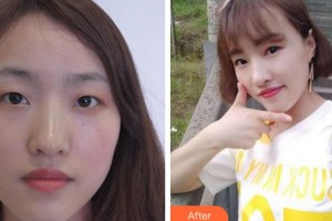 金華愛爾眼科醫(yī)院胡博磊整形價格表附切開雙眼皮案例展示