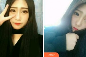 江蘇省口腔醫(yī)院于金華整形價格表附牙齒隱形矯正案例展示