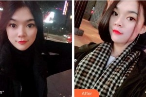 常州市口腔醫(yī)院趙金華整形價格表附牙齒隱形矯正案例展示