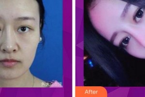 衢州美萊整形美容醫(yī)院黃盛高整形價格表附鼻部綜合案例展示