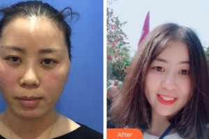 衢州美萊整形美容醫(yī)院袁帥整形價格表附埋線提升案例展示