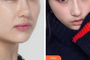 衢州美萊整形美容醫(yī)院劉富華整形價格表附埋線提升案例展示