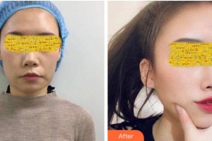 衢州美萊整形美容醫(yī)院謝磊整形價格表附除皺案例展示