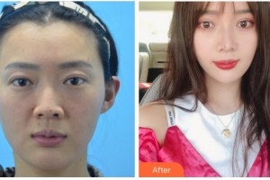 衢州美萊整形美容醫(yī)院陳愛云整形價格表附埋線提升案例展示