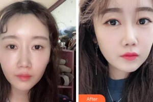 衢州市人民醫(yī)院整形美容科王秋明整形價格表附熱瑪吉案例展示