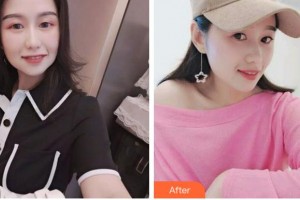 衢州市中醫(yī)院整形美容科楊順江整形價格表附埋線提升案例展示