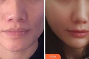 衢州民康醫(yī)院赫爾希整形美容中心張惠華整形價格表附埋線提升案例展示