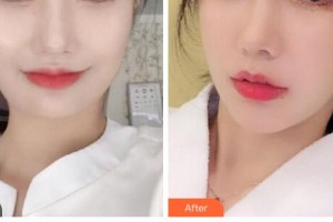 衢州芘麗芙整形美容醫(yī)院蔣小花整形價格表附埋線提升案例展示