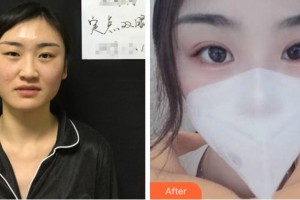 衢州芘麗芙整形美容醫(yī)院張小兵整形價格表附定點雙眼皮案例展示
