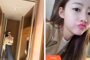 衢州芘麗芙整形美容醫(yī)院陳佑媛整形價格表附牙齒隱形矯正案例展示