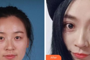 衢州芘麗芙整形美容醫(yī)院李威整形價格表附切開雙眼案例展示
