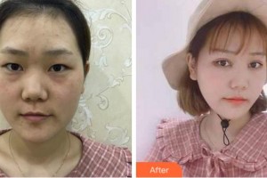 衢州愛爾眼科醫(yī)院麻張偉整形價格表附眼部綜合案例展示