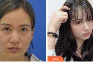 衢州愛爾眼科醫(yī)院李衛(wèi)整形價格表附激光去眼袋案例展示