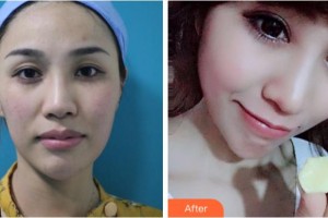 衢州市第二人民醫(yī)院眼科王慧琴整形價格表附眼部綜合案例展示