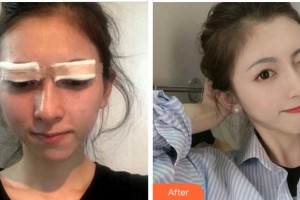 衢州市第二人民醫(yī)院眼科符建云整形價格表附切開雙眼皮案例展示