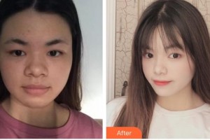 舟山普陀區(qū)人民醫(yī)院整形外科錢定國整形價格表附埋線提升案例展示