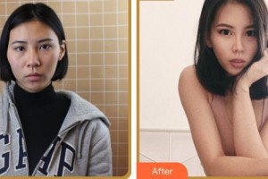 臺州新鳳凰醫(yī)學整形美容醫(yī)院陳國忠整形價格表附眼部綜合案例展示