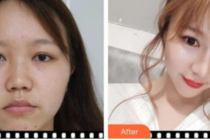 臺州新鳳凰醫(yī)學整形美容醫(yī)院井顯廉整形價格表附耳軟骨復合隆鼻案例展示