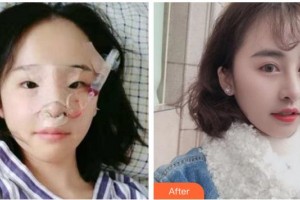 臺州新鳳凰醫(yī)學整形美容醫(yī)院張敬德整形價格表附鼻部綜合案例展示