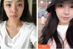 臺州博仕醫(yī)療整形美容醫(yī)院閆加鋒主診醫(yī)師整形價格表附肋軟骨隆鼻案例展示